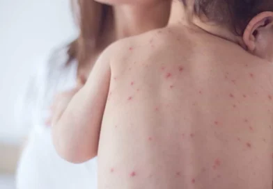 São Paulo tem primeiro caso de sarampo em 2026