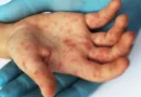 Quão perigoso é o sarampo? Sintomas para ficar de olho e como se proteger